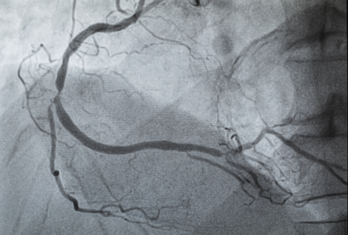 Heart diseases are among the leading causes of death in India.