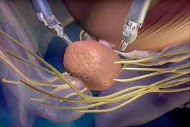 Free Prostate Operation
