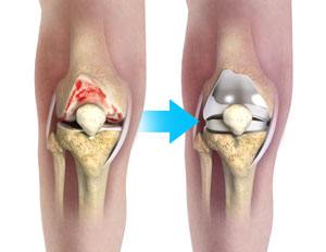 Are you struggling with chronic knee pain that affects your daily life? Knee replacement surgery can be a life-changing solution.